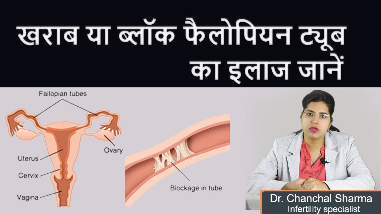 Blocked Fallopian Tubes Treatment